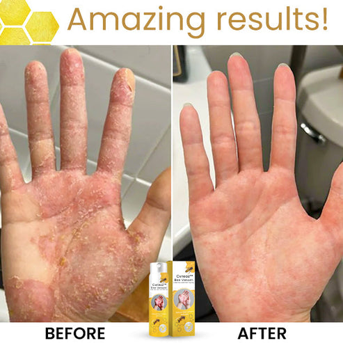 Bee Venom Eczema Treatment Spray – 💥 Last Day Sale Off 60% 🔥